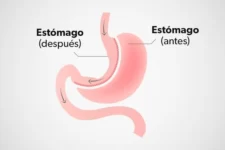 cirugia-bariatrica_28306_l